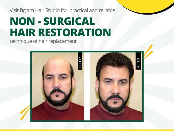 non surgical hair replacement in hyderabad