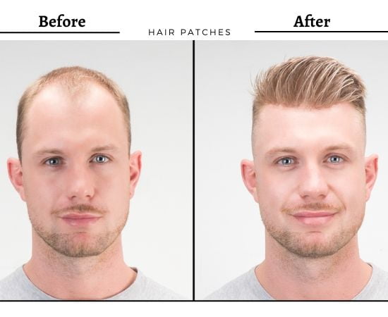Non-surgical Hair Replacement in Bangalore - Bglam
