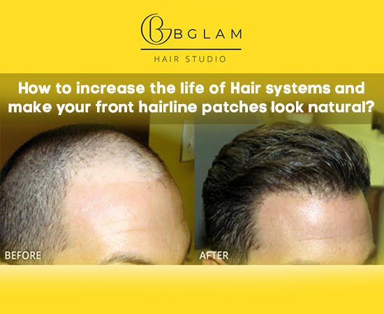 How to increase the life of Hair systems and make your front hairline  patches look natural? - Bglam