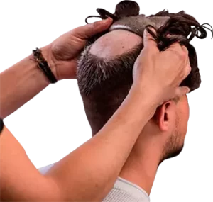 Fixing hair Patch in Hyderabad
