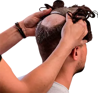 Fixing hair Patch in Hyderabad