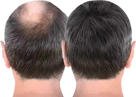 Hair bonding experts in Hyderabad