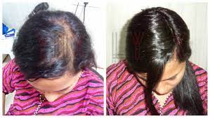 Organic hair replacement Hyderabad