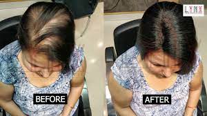 Natural-looking hair replacement Hyderabad
