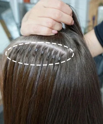 Non-surgical hair integration Hyderabad