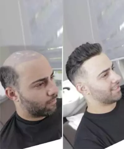 Hair implantation Hyderabad