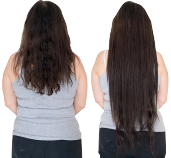 Hair replacement in Hyderabad