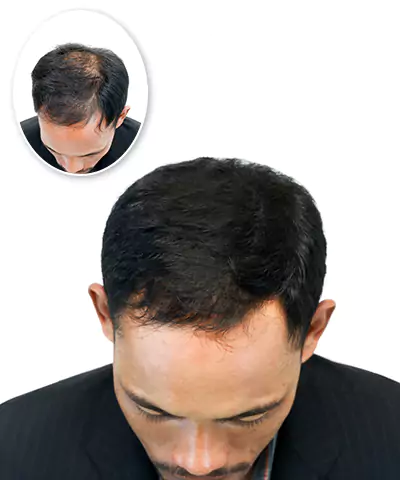 Hair loss treatment centers nearby