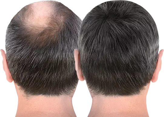 hair replacement in hyderabad
