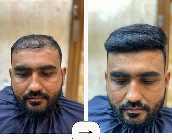 Advanced hair replacement techniques in Hyderabad
