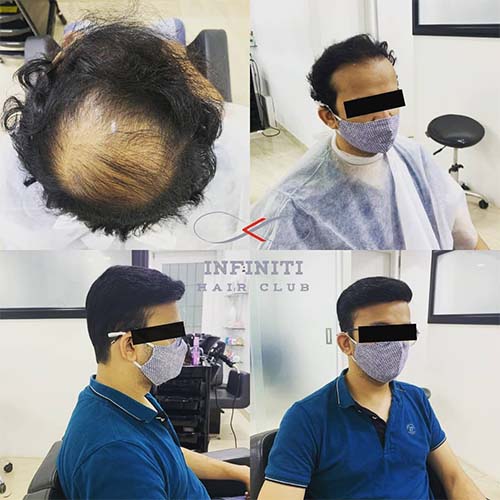 Hair regrowth treatments in Hyderabad
