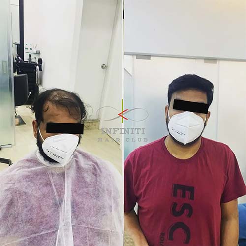 Hair implantation in Hyderabad