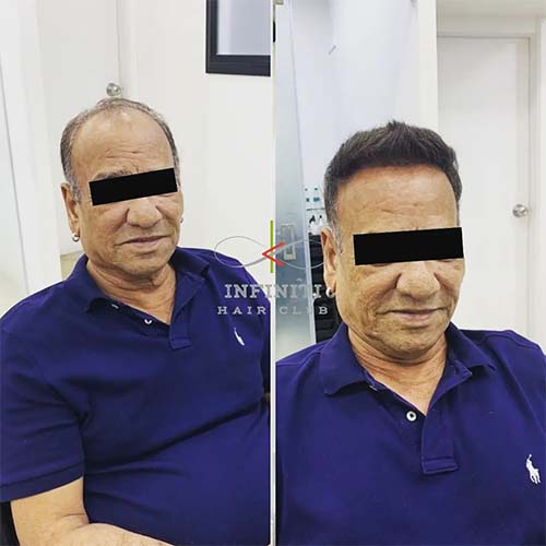 Hair restoration in Hyderabad