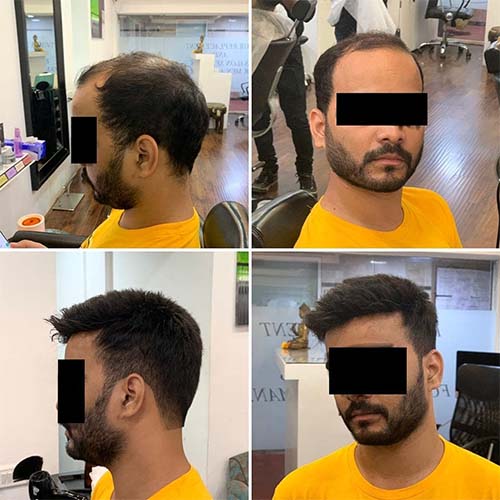 Hair grafting in Hyderabad