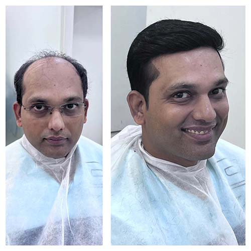 Hair transplant surgeon in Hyderabad
