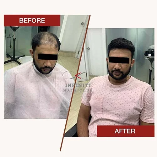 Hair loss clinic in Hyderabad