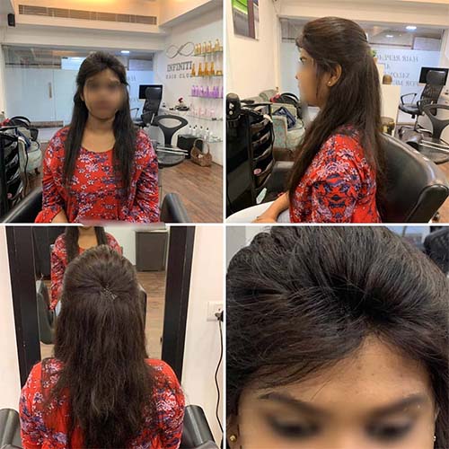 Best hair replacement clinics in Hyderabad