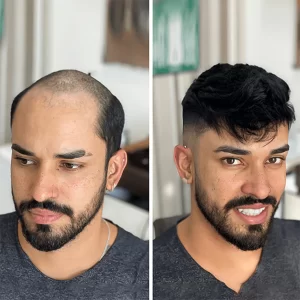 Hair Wigs in Hyderabad