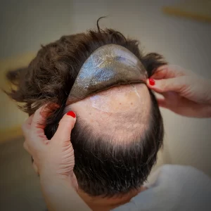 Hair patch in Hyderabad