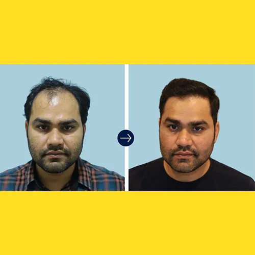 Non-Surgical Hair Replacement In BHEL
