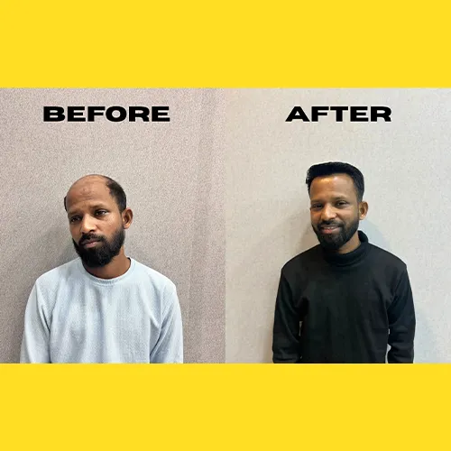Non-surgical hair replacement In Habsiguda