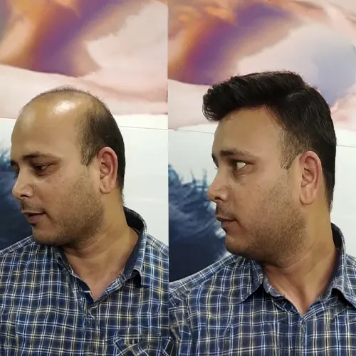 Hair Patch services in Punjagutta