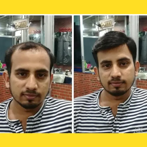 Non-Surgical Hair Replacement In Kukatpally