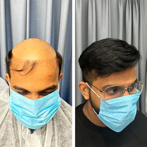 Non-Surgical Hair Replacement In Moosapet