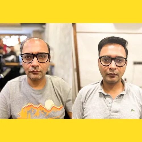 Non-Surgical Hair Replacement In SR Nagar