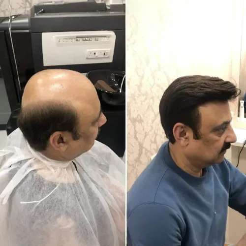 Hair Patch services in Secunderabad