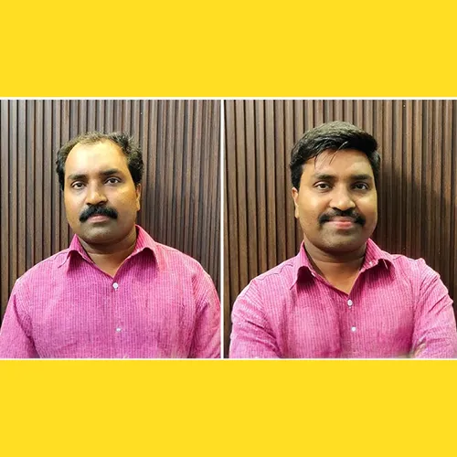 Non-Surgical Hair Replacement Near Marathahalli