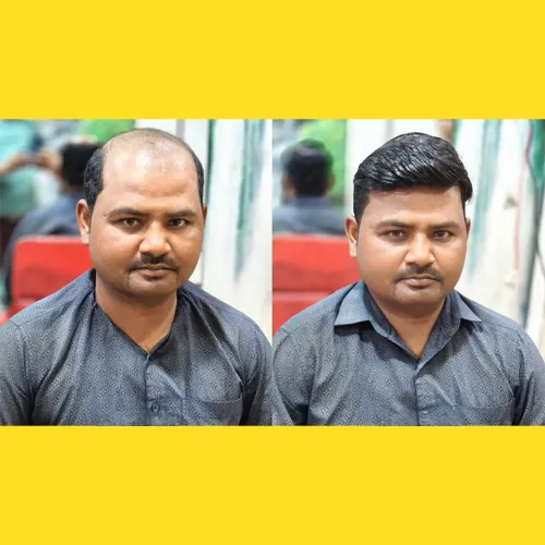 Non-Surgical Hair Replacement Price In Marathahalli