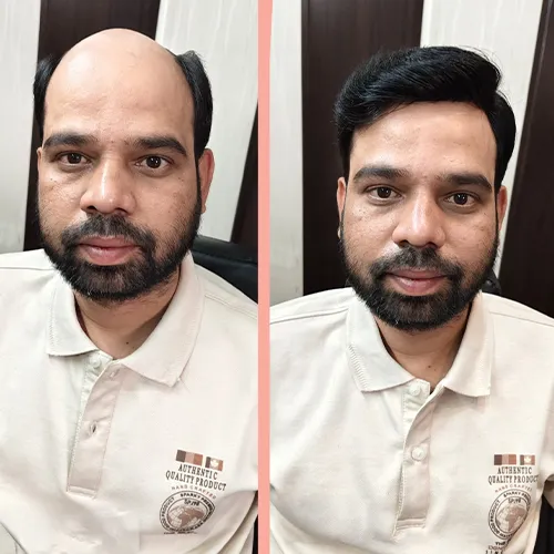 Non Surgical Hair Replacement In Bangalore