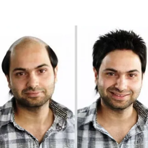 Hair Patch Near Marathahalli