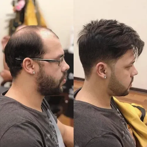 Hair Patch Service In Bangalore