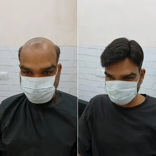 Hair Patch In Jaya Nagar