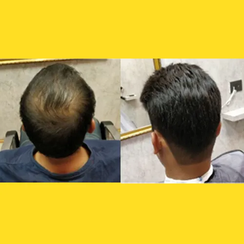 Hair Patch In JP Nagar