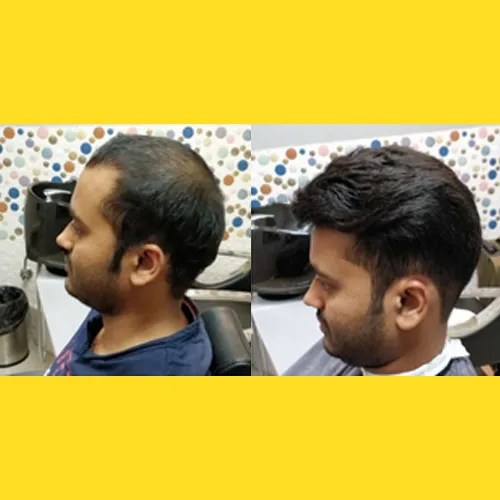 Hair Patch In Koramangala