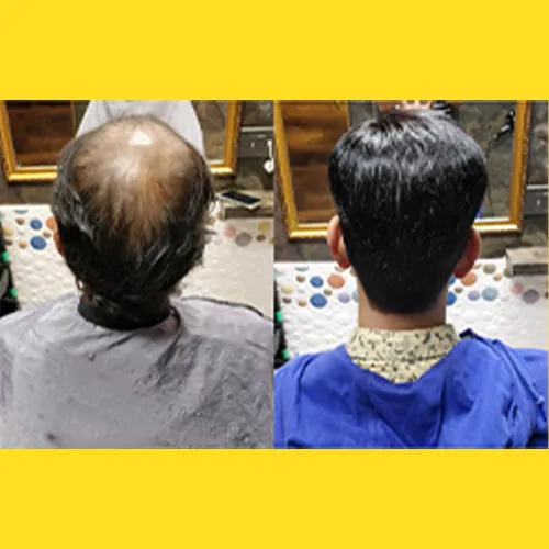 Hair Patch In MG Road
