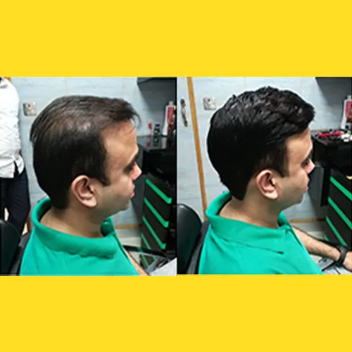 Hair Patch In Nelamangala