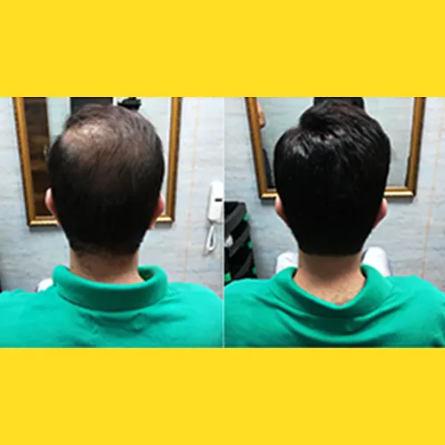 Hair Patch In Trinity