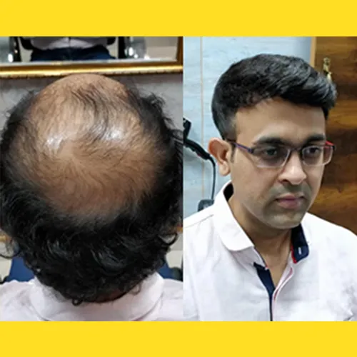 Hair Patch in Kondapur
