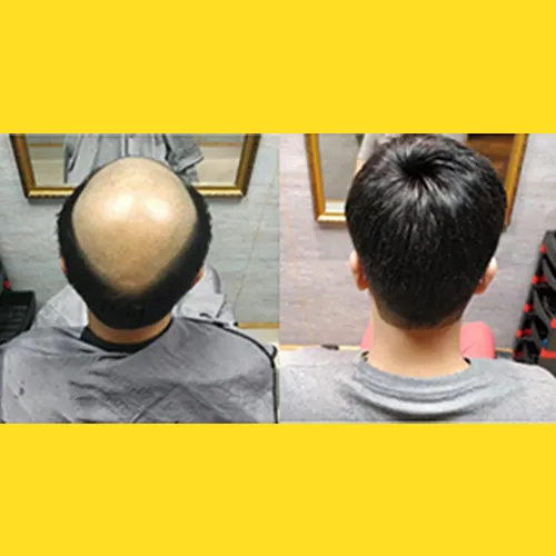 Hair patches in Bangalore