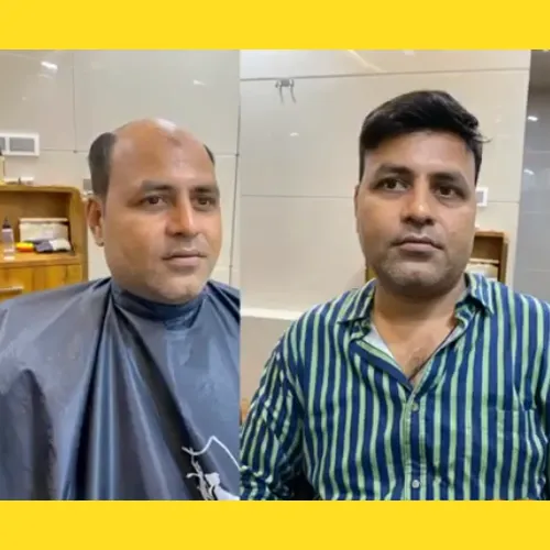 Non-Surgical Hair Replacement in Banashankari
