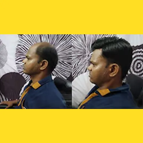 Non Surgical Hair Replacement in Electronic City