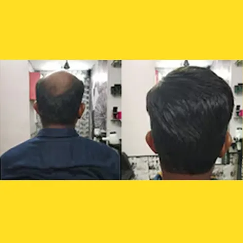 Non Surgical Hair Replacement in Hebbal
