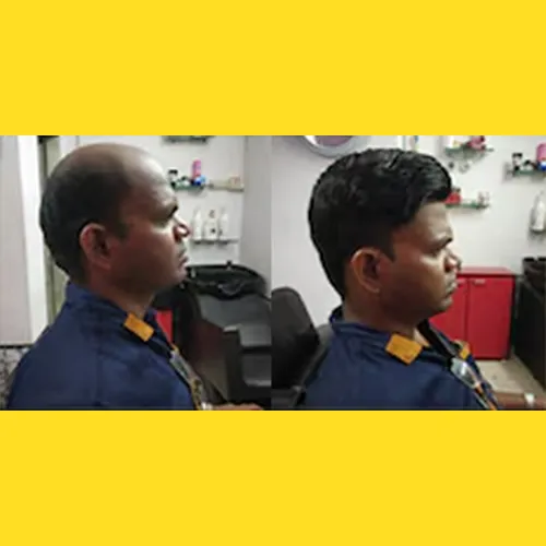 Non Surgical Hair Replacement in Hoskote