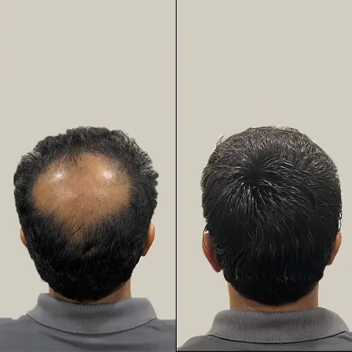 Hair Patch services in Kompally