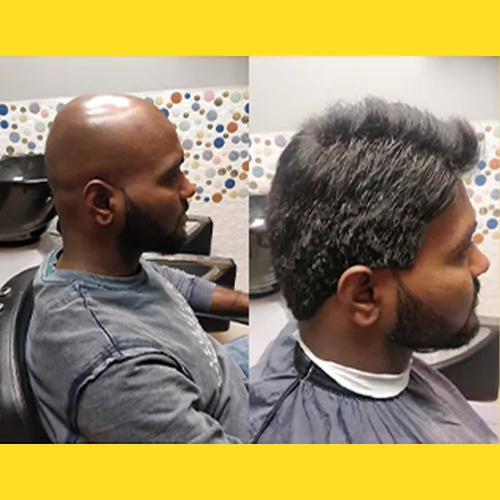 Non Surgical Hair Replacement in HSR