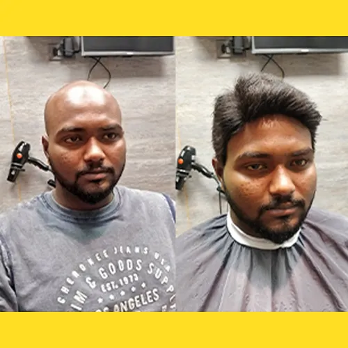 Non Surgical Hair Replacement in Indira Nagar